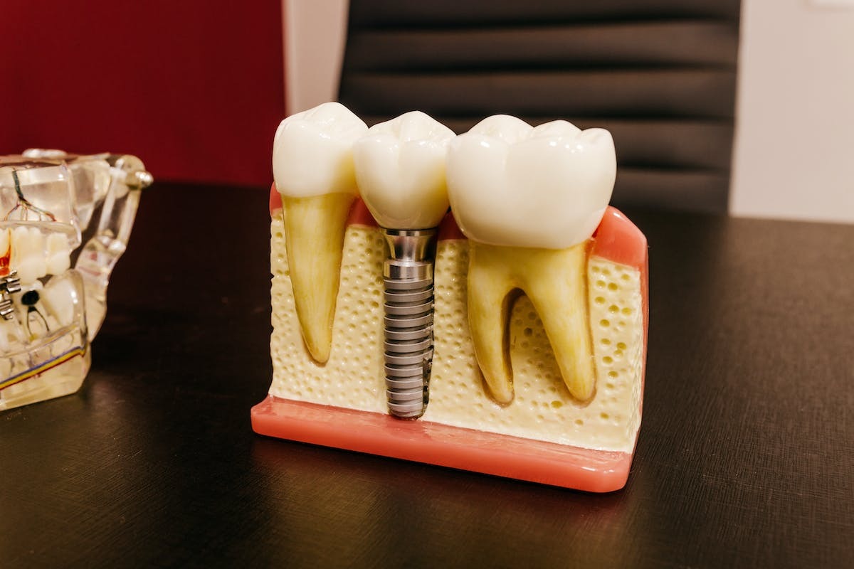 Comment bénéficier de la prise en charge des implants dentaires par la CMU